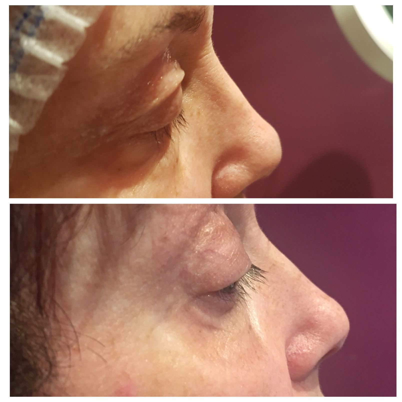 fibroblasting before and after