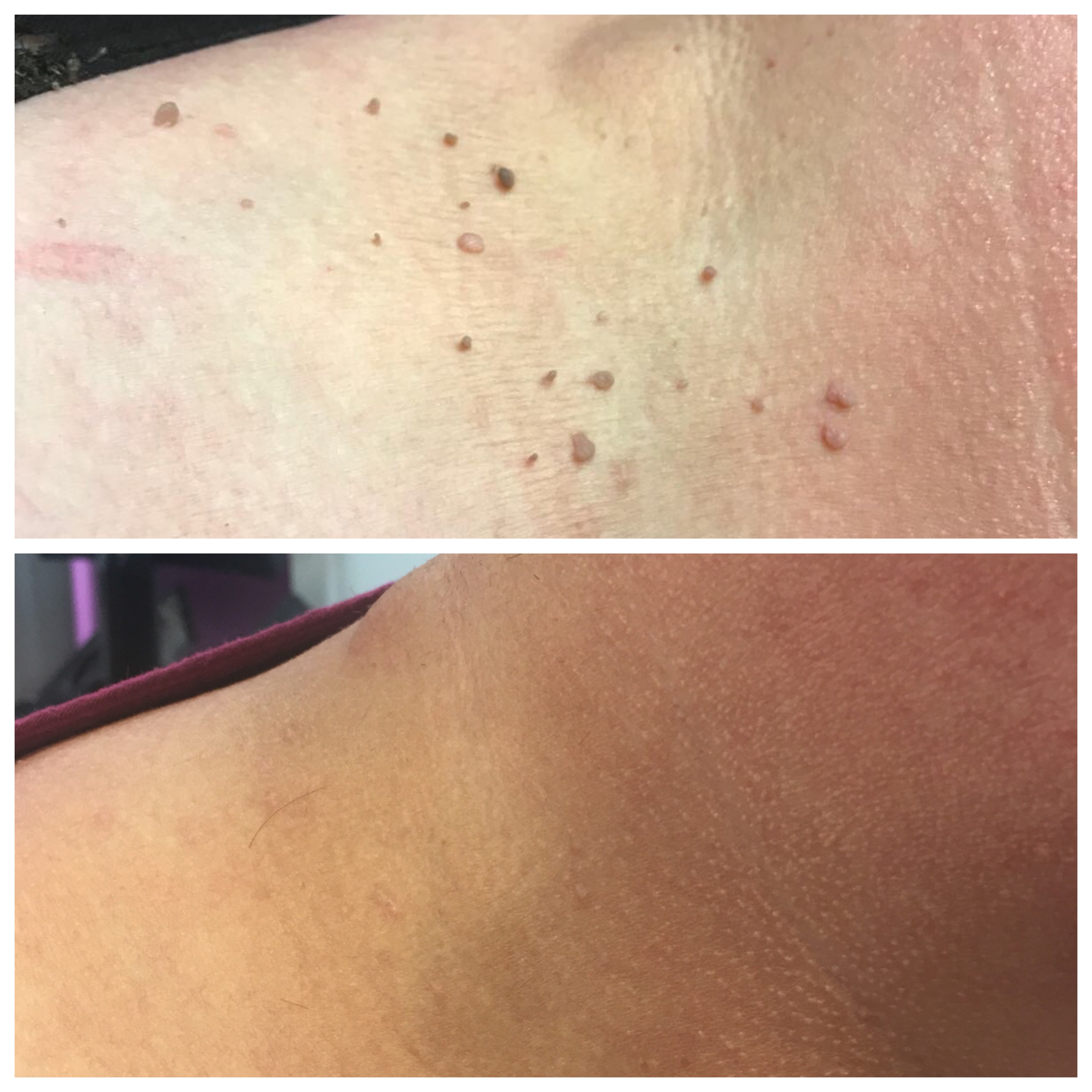 fibroblasting before and after